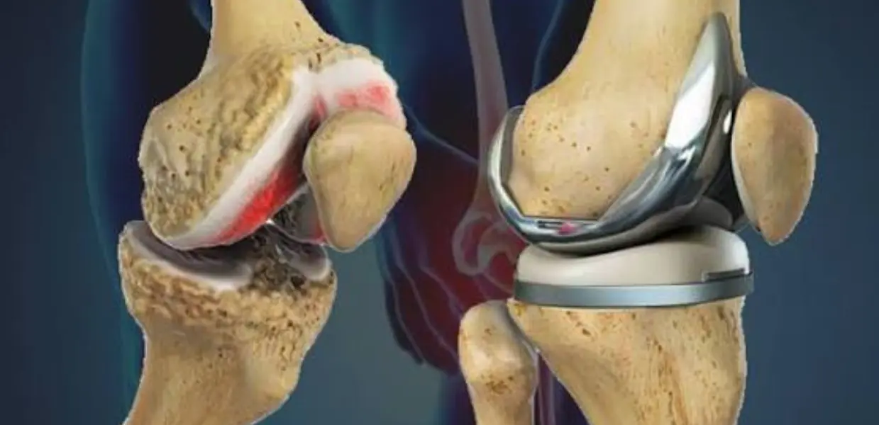Knee Replacement in India for Mauritius Patients